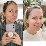 ENCA acne clearing set before and after results showing clearer skin and reduced acne appearance