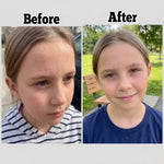 ENCA acne clearing skincare before and after results showing improved skin clarity and reduced breakouts