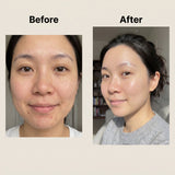 Acne clearing before and after results using ENCA cleanser and moisturiser skincare set